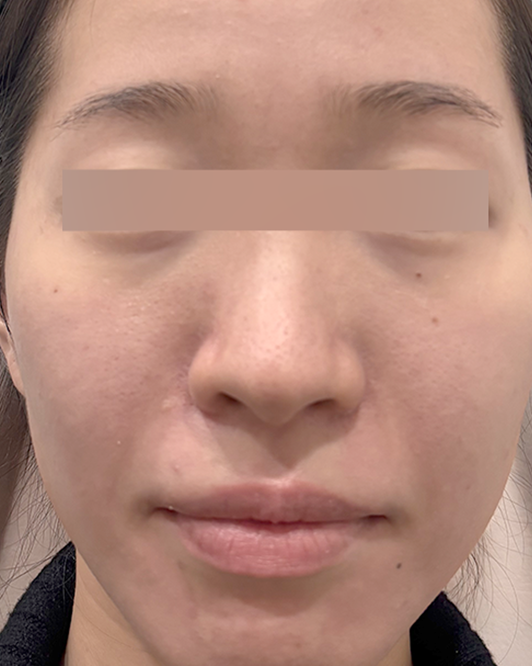 쥬베룩 볼륨(팔자) 3cc + (옆볼) 6cc