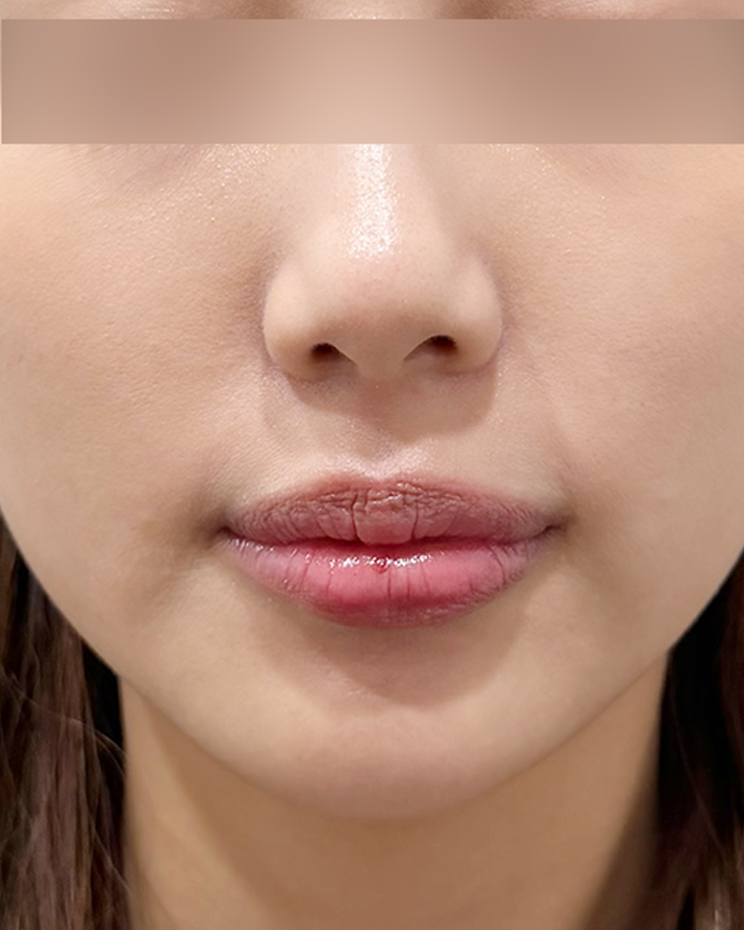 턱필러