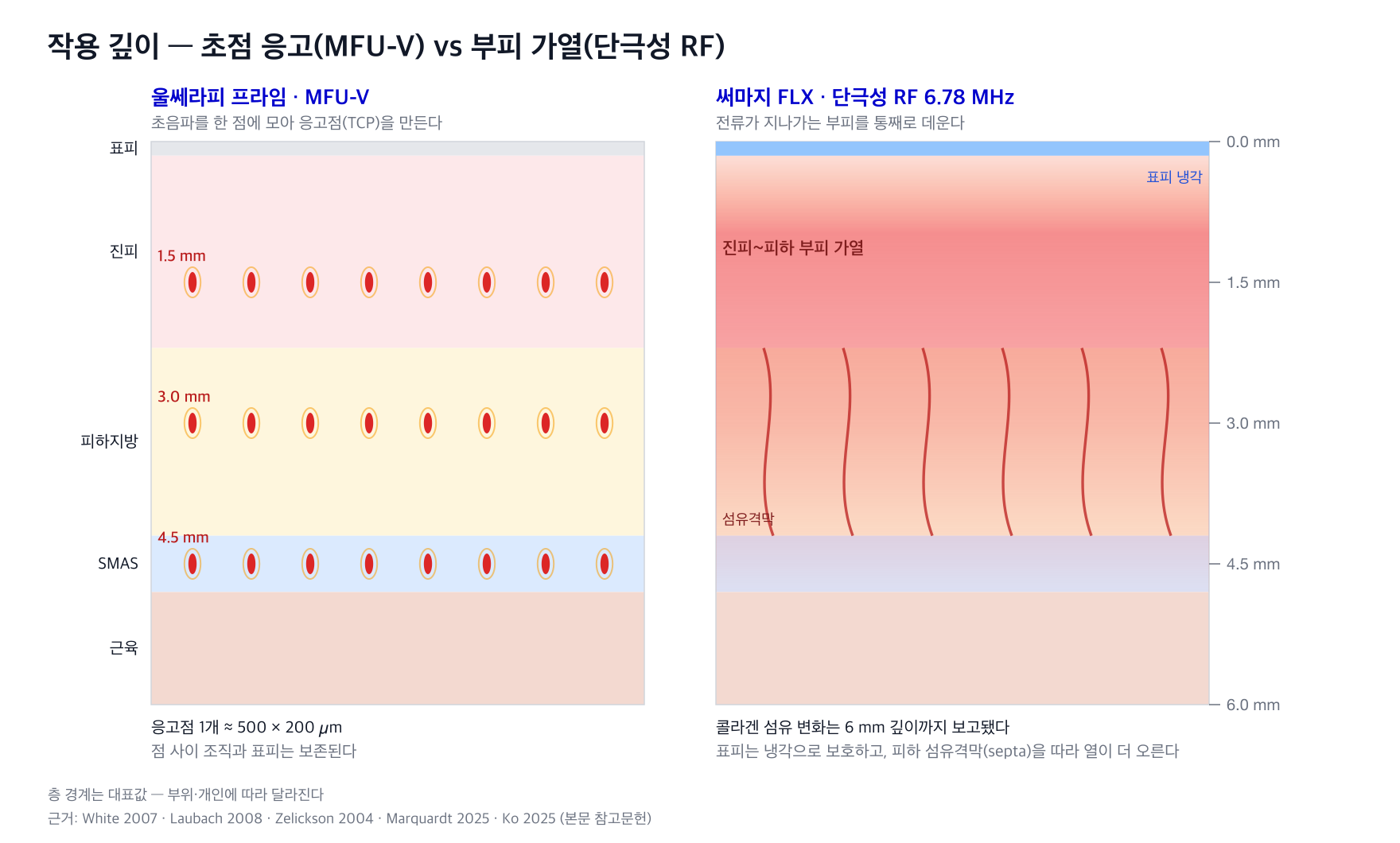 작용 깊이 비교 도해 — MFU-V 초점 응고와 단극성 RF 부피 가열